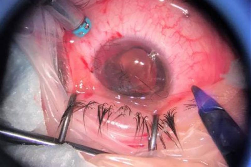 Екатеринбургские офтальмологи вернули зрение ребёнку, в глазу которого застрял гигантский осколок петарды